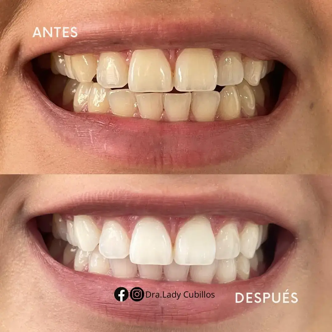 servicio blanqueamiento Dental